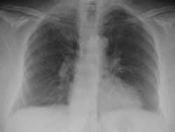 Imagen malapraxis-pulmonia